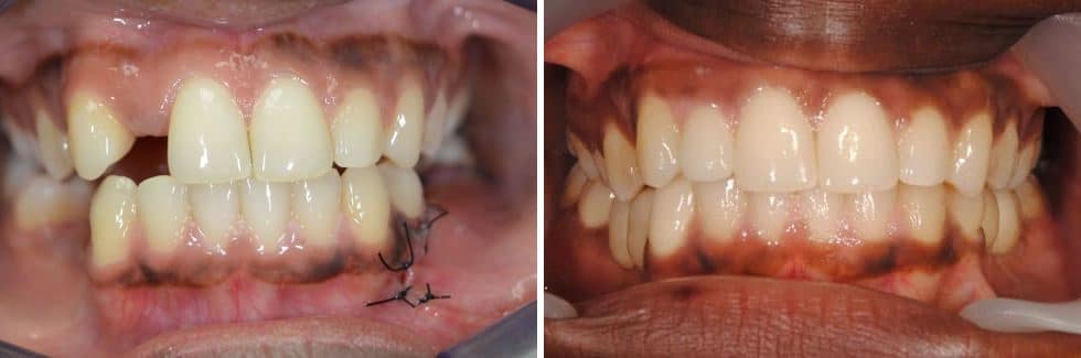 implantátum csontpótlas