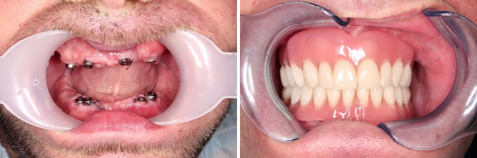 Fog Implantatum Gyakori Kerdesek
