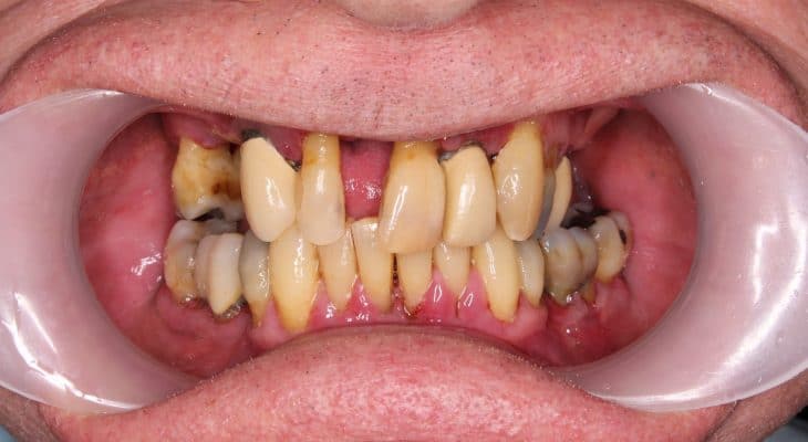 parodontitis esetén rossz lehelet lehet
