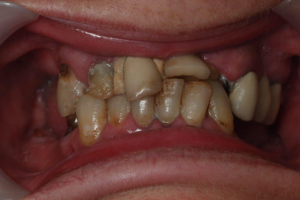 parodontitis esetén rossz lehelet lehet)